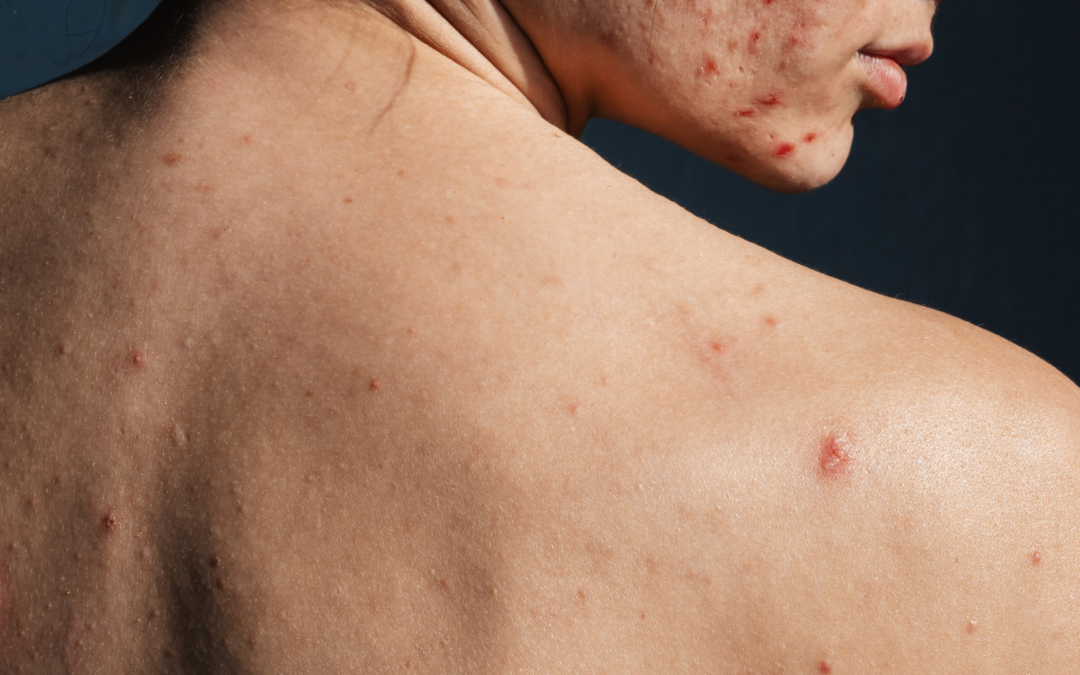 Acne: Causas, Tipos, Tratamentos e Prevenção