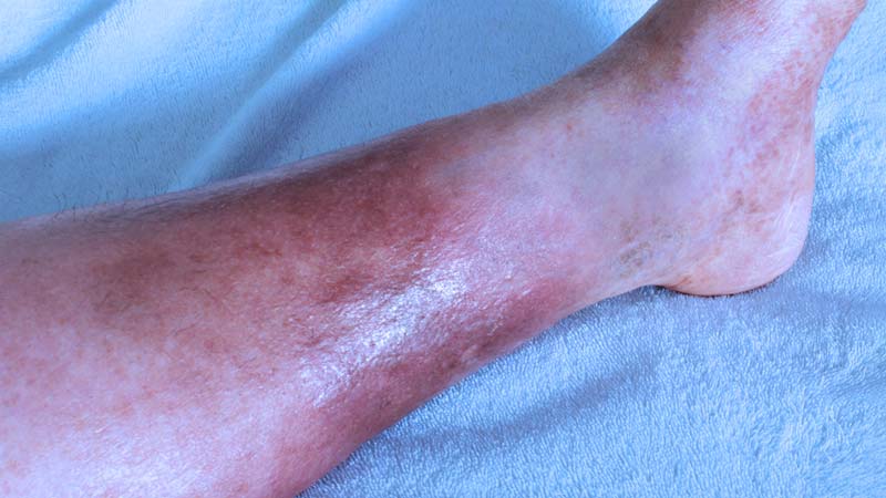 dermatite-estase
