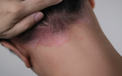 Dermatite seborreica e Blefarite: o que são, causas, sintomas e tratamentos