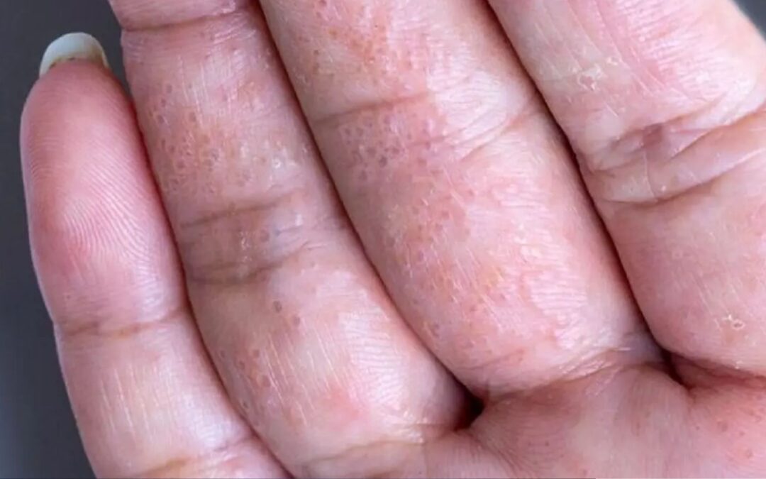 Disidrose: entenda essa forma peculiar de eczema
