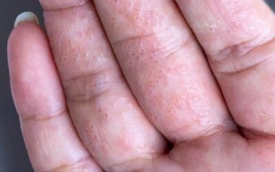Disidrose: entenda essa forma peculiar de eczema