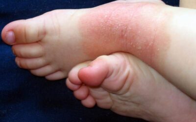 Eczema infantil: o que é, causas, sintomas e como cuidar da pele do bebê