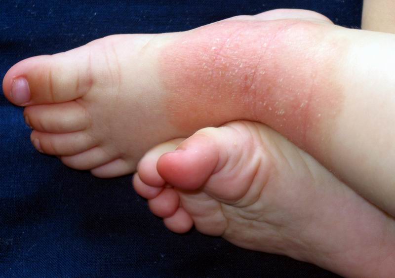 Eczema infantil: o que é, causas, sintomas e como cuidar da pele do bebê