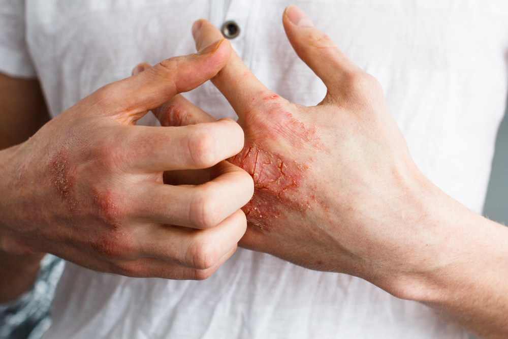 Eczema Atópica e Eczema de Contato: causas e cuidados essenciais com a pele