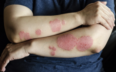 Eczema Numular: O Eczema Em Forma De Moedas