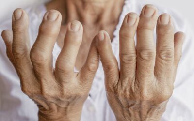 Artrite reumatoide: o que é, sintomas, tratamento e mitos