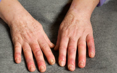 Esclerodermia: o que é, sintomas, causas e tratamento