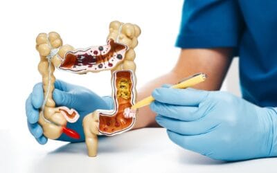 Câncer colorretal: causas, sintomas, diagnóstico, tratamento e prevenção