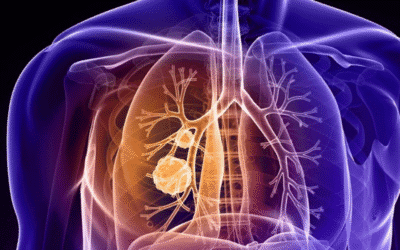 Fibrose cística: causas, sintomas, tratamento, mitos e qualidade de vida