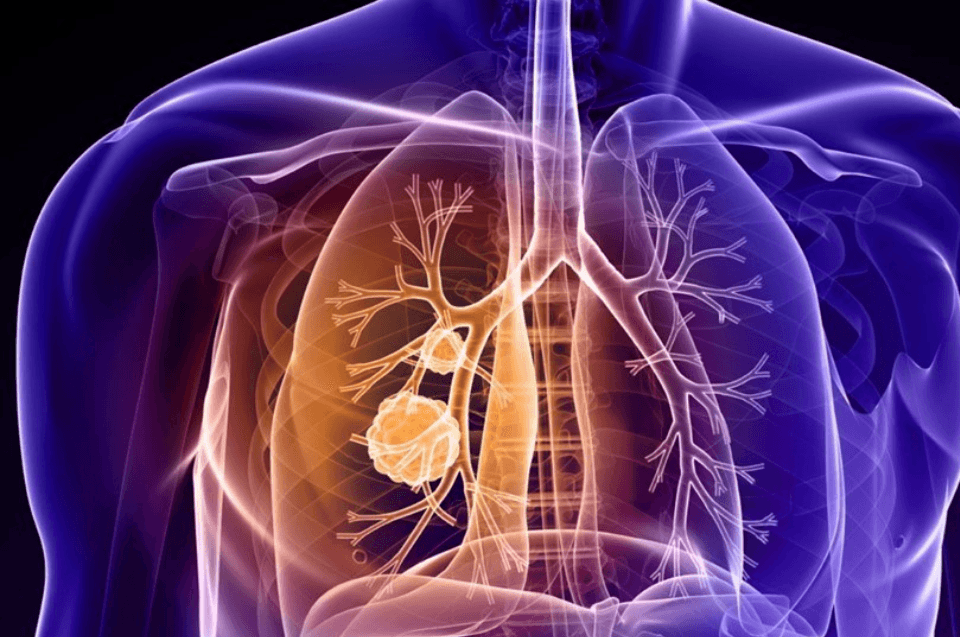 Fibrose cística: causas, sintomas, tratamento, mitos e qualidade de vida