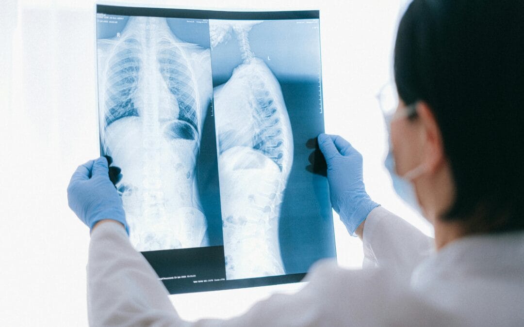 Chronic Obstructive Pulmonary Disease (COPD): Symptoms, Causes, and Treatment