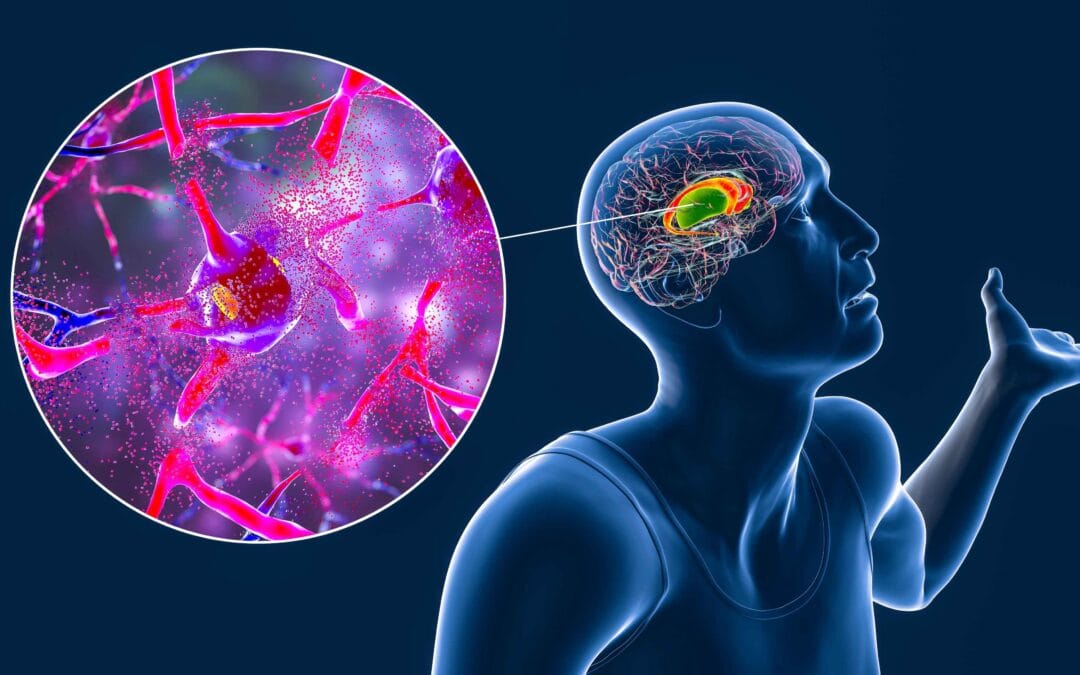 Doença de Huntington: sintomas, causas genéticas, diagnóstico, tratamento e avanços