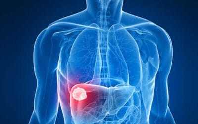 Hepatite A: sintomas, causas, prevenção e tratamento