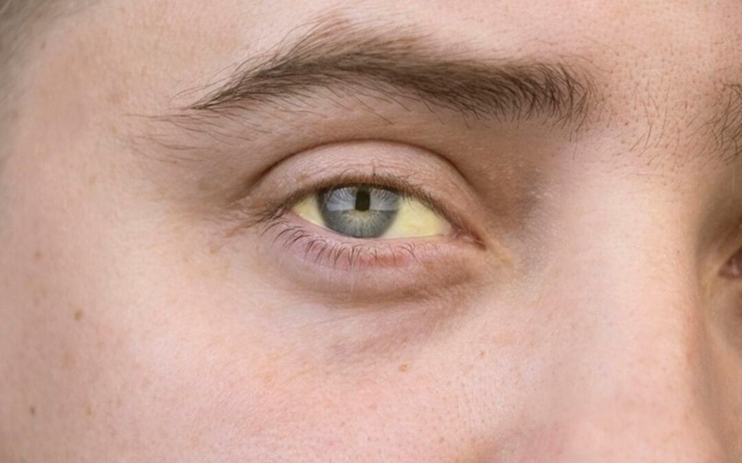 Hepatitis B: Symptoms, Transmission, Diagnosis, and Treatment