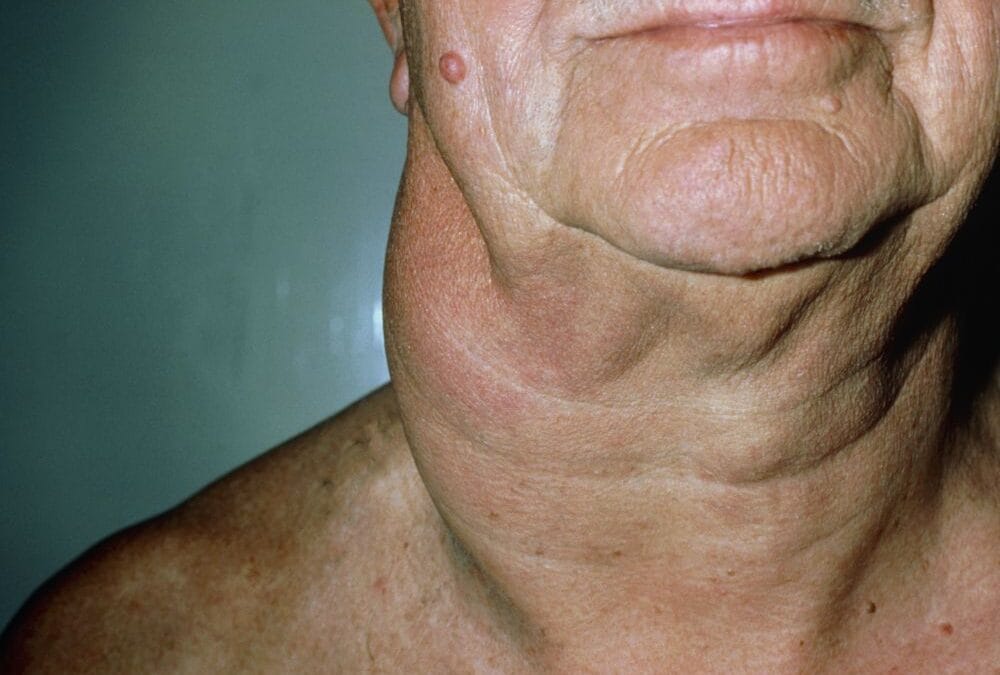 Linfoma não Hodgkin (LNH): sintomas, causas, diferenças e tratamento