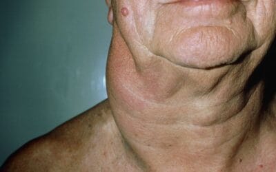 Linfoma não Hodgkin (LNH): sintomas, causas, diferenças e tratamento