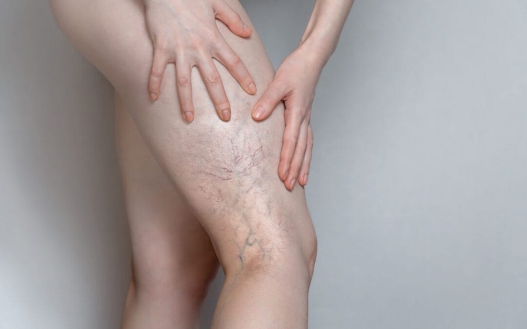 Trombose: sintomas, fatores de risco, diagnóstico, tratamento e prevenção