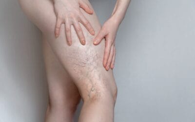 Trombose: sintomas, fatores de risco, diagnóstico, tratamento e prevenção