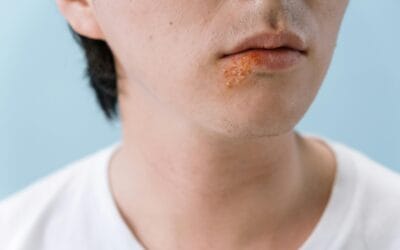 Herpes (HSV-1 e HSV-2): sintomas, transmissão, diagnóstico, tratamento e prevenção