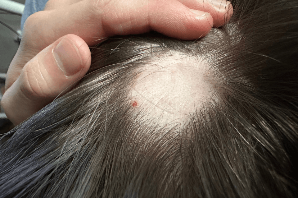 Alopecia: tipos, causas, diagnóstico, tratamento e quando procurar ajuda