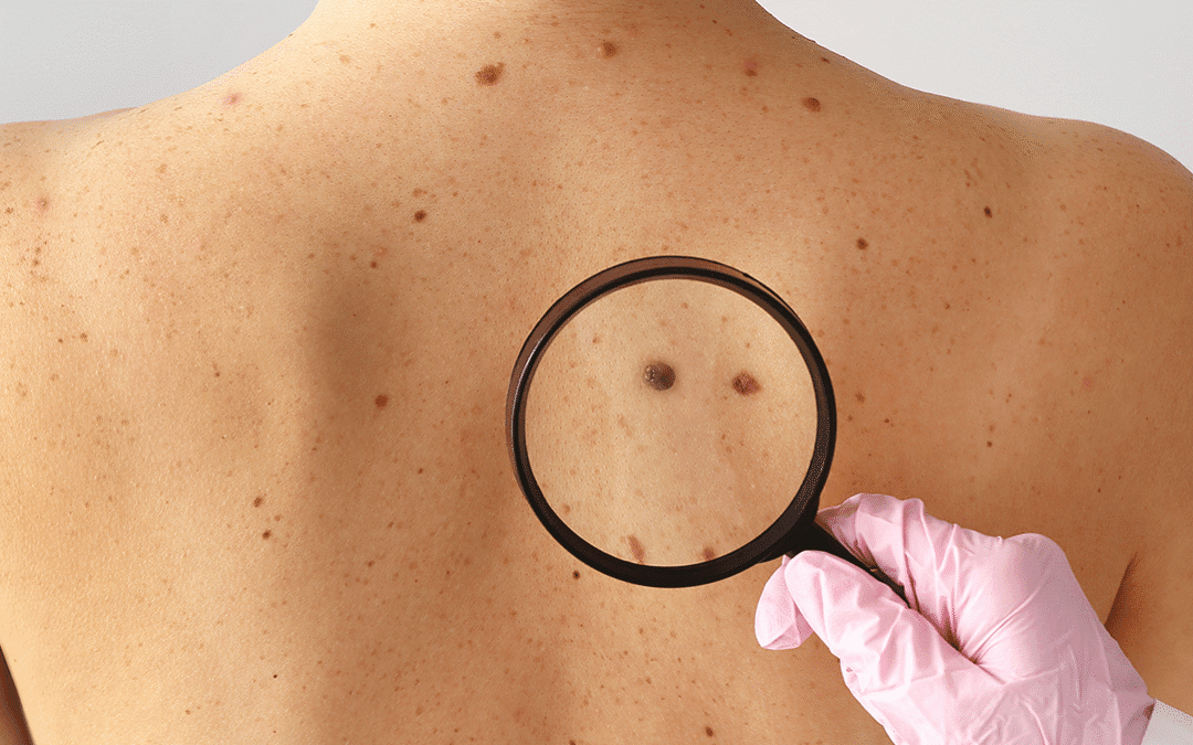 Melanoma: sinais, diagnóstico, estadiamento, tratamento e prevenção