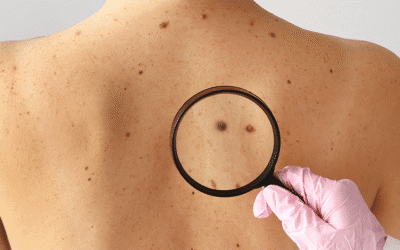 Melanoma: sinais, diagnóstico, estadiamento, tratamento e prevenção
