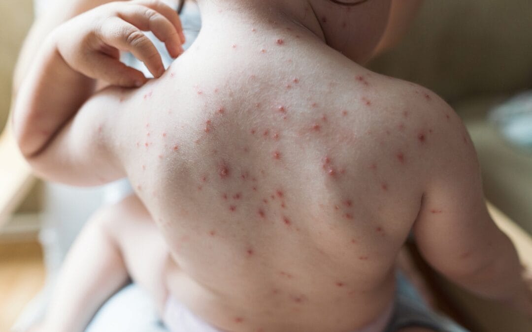 Rubéola: sintomas, diagnóstico, riscos na gestação, tratamento e prevenção com vacina