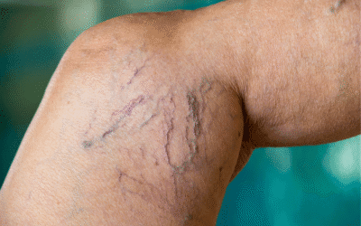 Varizes: sintomas, causas, diagnóstico, tratamento, prevenção e quando procurar ajuda