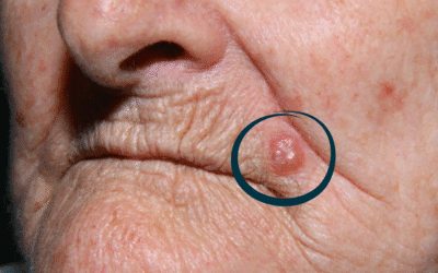 Carcinoma Basocelular: sintomas, causas, diagnóstico, tratamento, prevenção e quando procurar ajuda