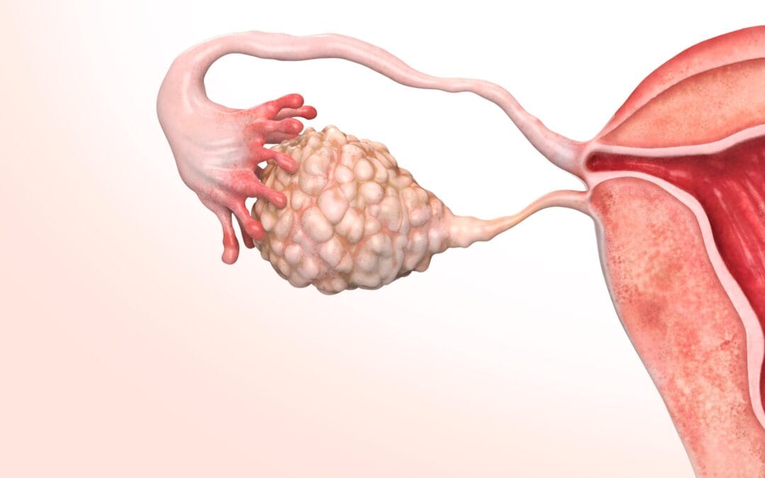 Síndrome dos Ovários Policísticos (SOP): sintomas, causas, diagnóstico, tratamento e quando se preocupar