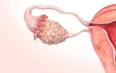 Síndrome dos Ovários Policísticos (SOP): sintomas, causas, diagnóstico, tratamento e quando se preocupar