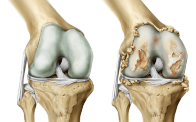 Artrose (osteoartrite): sintomas, causas, diagnóstico, tratamento e como aliviar a dor