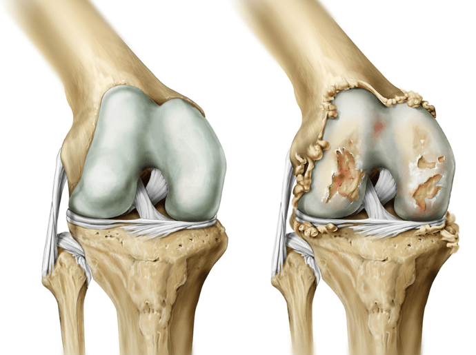 Osteoarthritis (Arthrosis): symptoms, causes, diagnosis, treatment, and how to manage joint pain