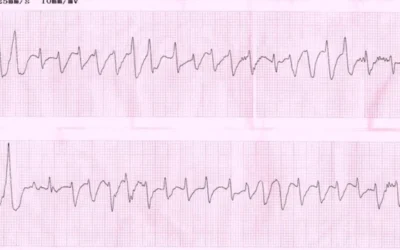 Taquicardia ventricular: arritmia grave, risco de morte súbita, sintomas e tratamento