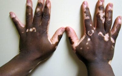 Vitiligo: o que é, causas, sintomas, tratamento e quando procurar um dermatologista