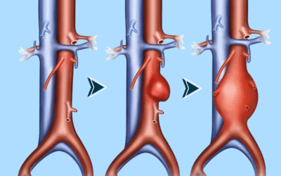 Aneurisma da aorta: dilatação silenciosa, risco de ruptura, diagnóstico e tratamento