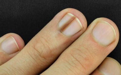 Câncer de unha: linha marrom na unha, melanoma ungueal e outros sinais de alerta