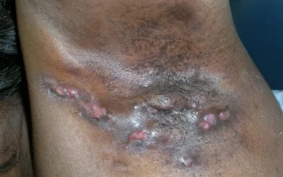 Hidradenite supurativa: caroços dolorosos, inflamação nas dobras da pele e tratamento