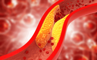 Aterosclerose: placas nas artérias, risco de infarto e AVC, diagnóstico e tratamento