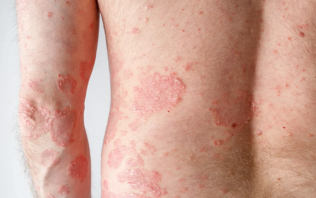 Pitiríase rósea: manchas rosadas na pele, causas, sintomas e tratamento