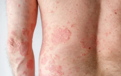 Pityriasis rosea: pink scaly patches, causes, symptoms, and treatment