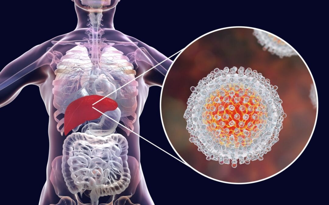 Hepatitis C: transmission, symptoms, diagnosis, treatment, and the possibility of cure