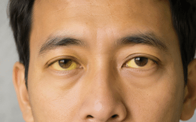 Hepatitis D: the virus that depends on hepatitis B, transmission, diagnosis, and treatment