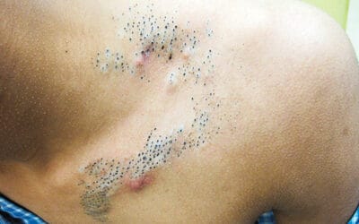 Nevus comedonicus: blackhead-like skin lesions, causes, diagnosis, and treatment