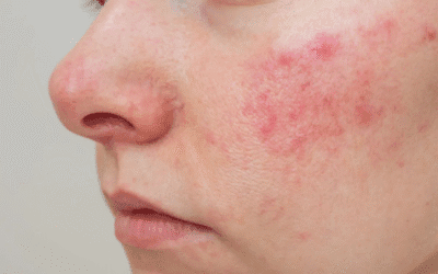 Rosacea: facial redness, triggers, symptoms and treatment